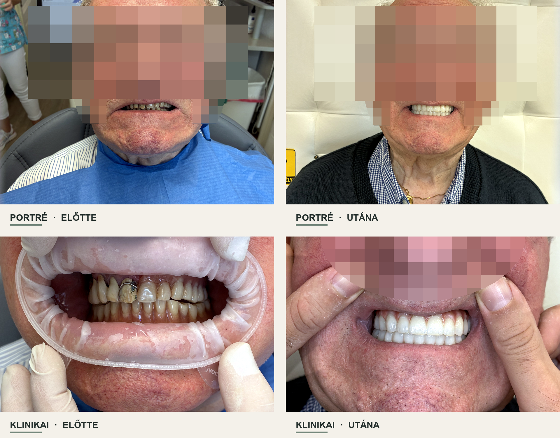 A második Eudent páciens portré- és klinikai fotói a kezelés előtt és után
