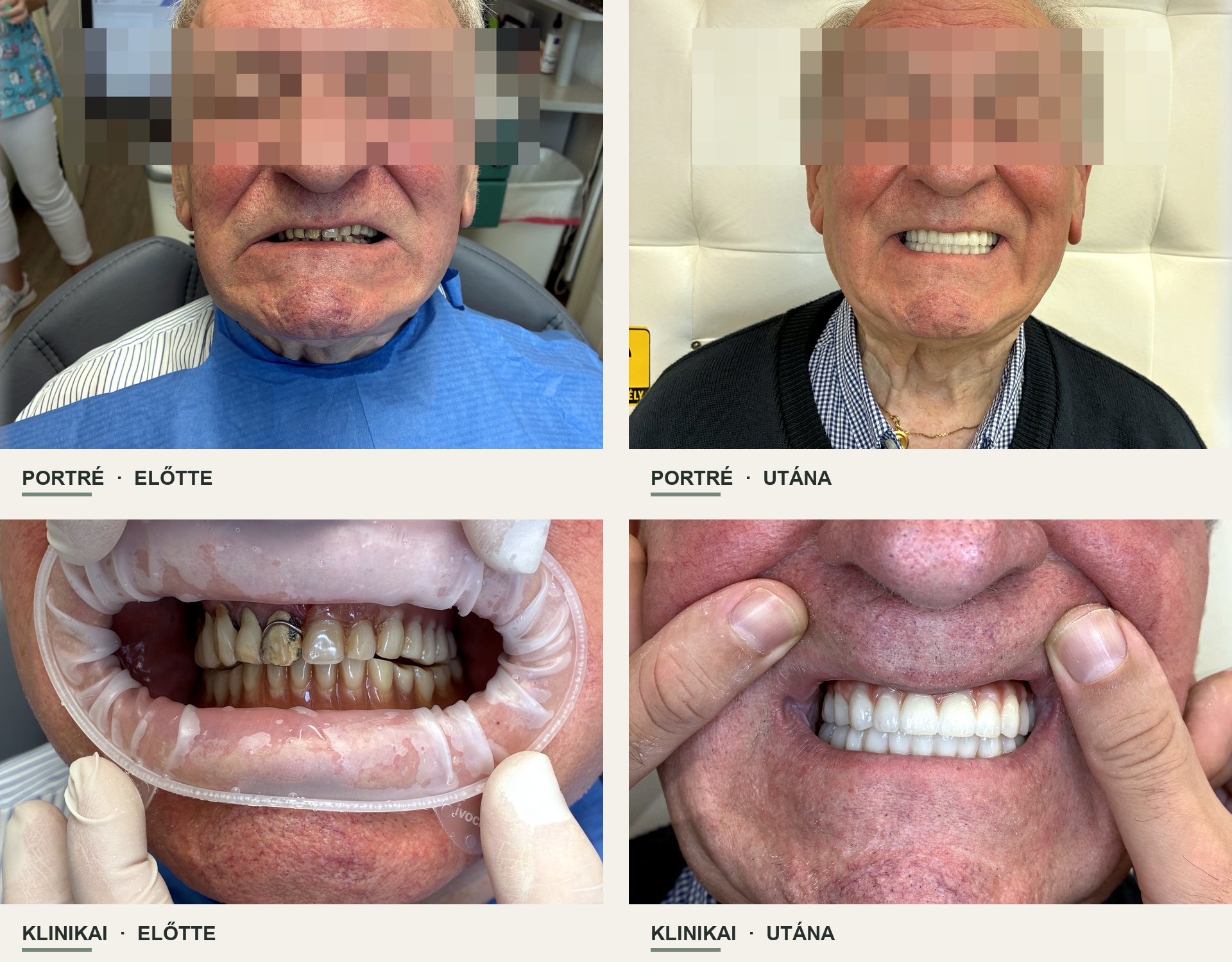 A második Eudent páciens portré- és klinikai fotói a kezelés előtt és után